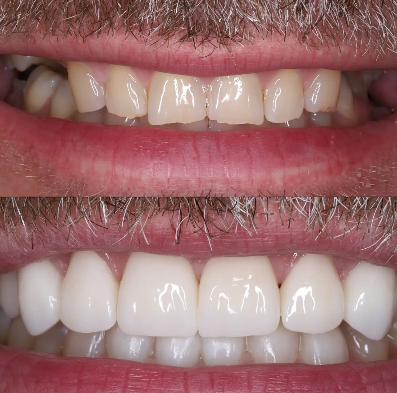 Улыбка до и после композитных виниров — работа Myronenko Dental Studio