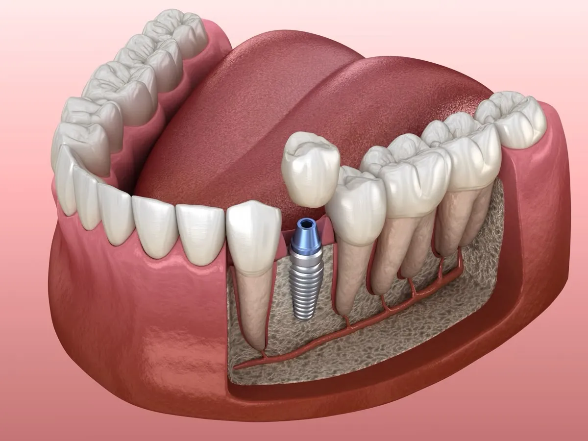 Імплантація зубів у клініці Myronenko Dental Studio, Київ
