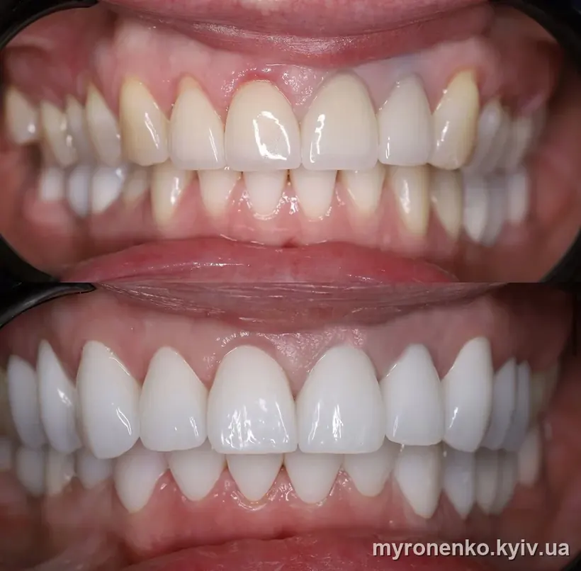 Усмішка до і після лікування — Myronenko Dental Studio