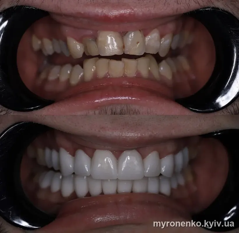 Усмішка до і після лікування — Myronenko Dental Studio
