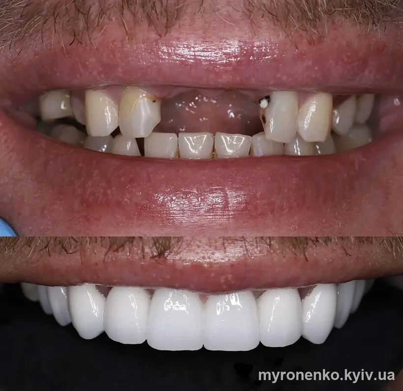 Усмішка до і після лікування — Myronenko Dental Studio