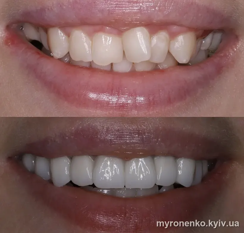 Усмішка до і після лікування — Myronenko Dental Studio
