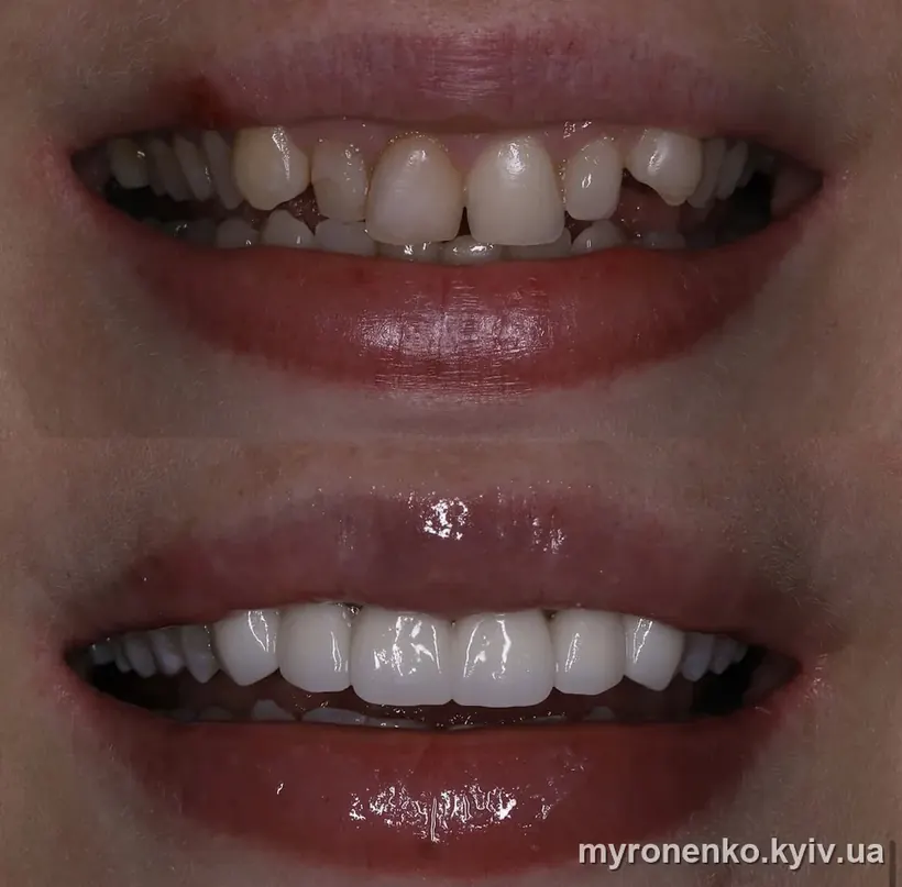 Усмішка до і після лікування — Myronenko Dental Studio