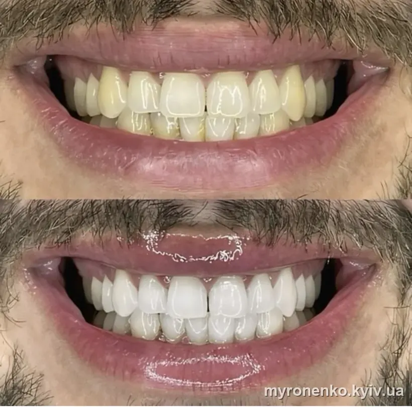 Усмішка до і після лікування — Myronenko Dental Studio