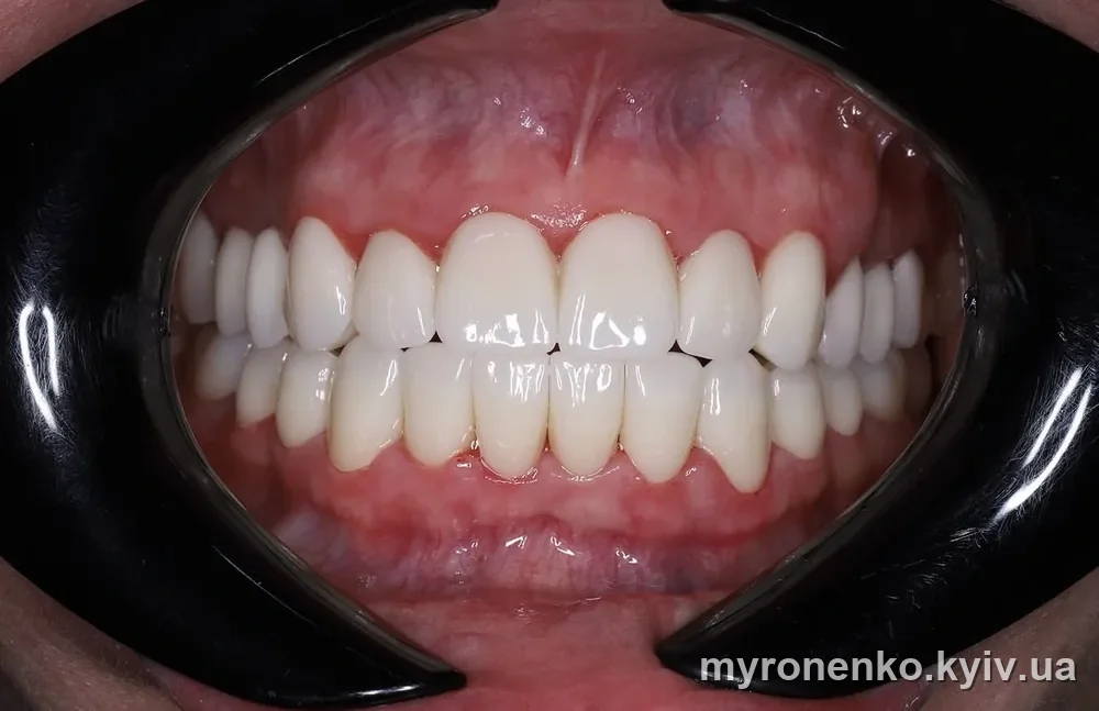 Професійна гігієна та чистка зубів — Myronenko Dental Studio