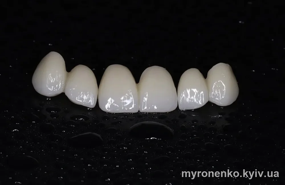Цільнокерамічний мостоподібний протез — робота лабораторії Myronenko Dental Studio