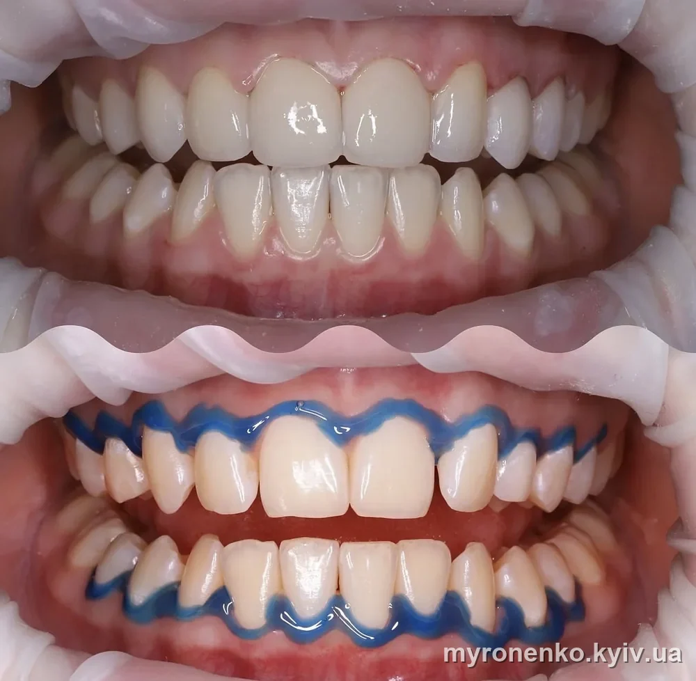 Відбілювання зубів — результат до і після, Myronenko Dental Studio