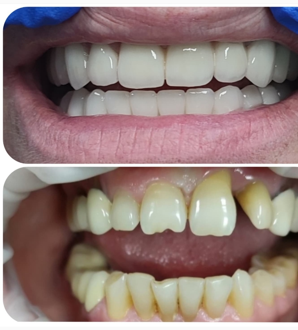Реставрація зубів